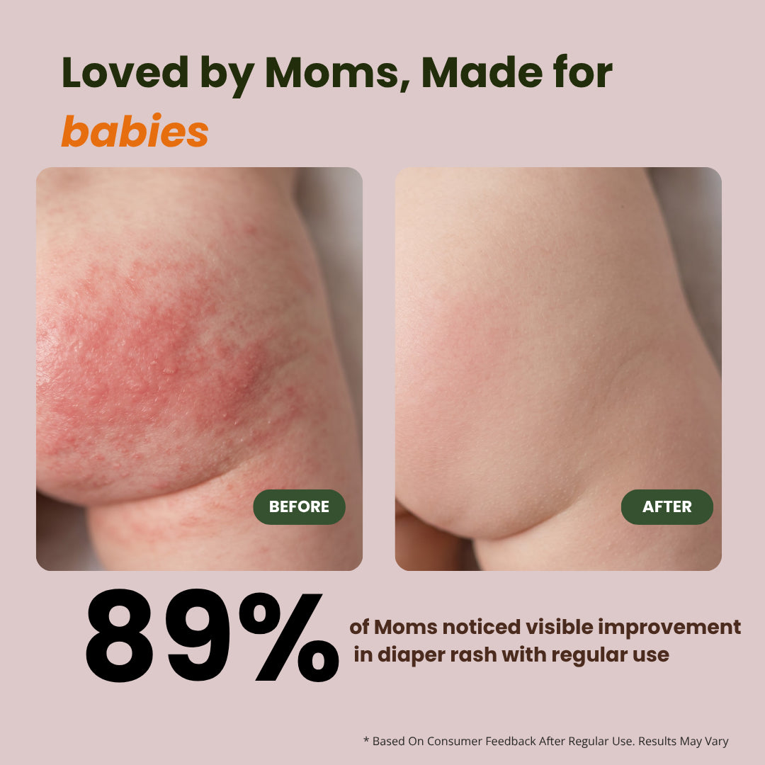 Diaper Rash Cream for Babies
